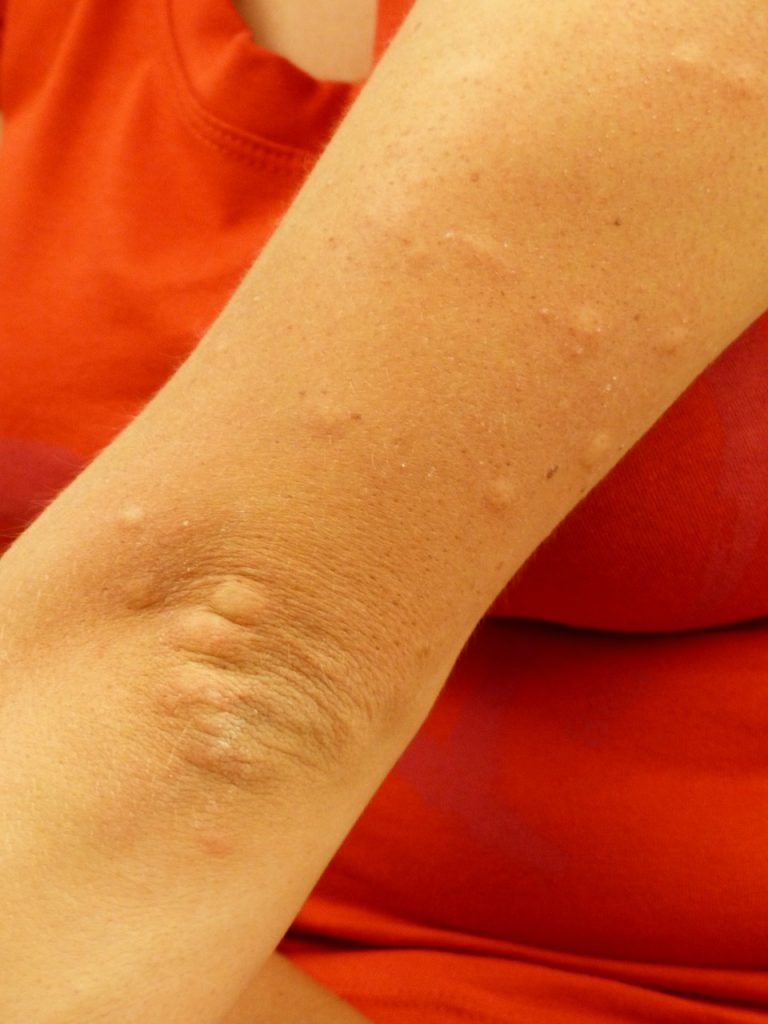 Problemy skórne w alergii